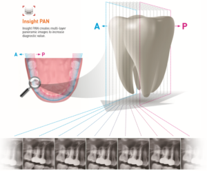 OPG Multilayer