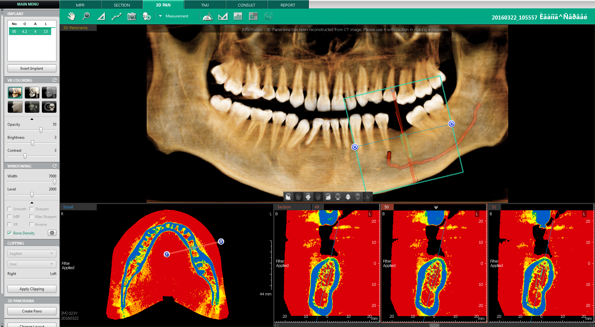 IMPLANT SIMULATION with 3D PAN